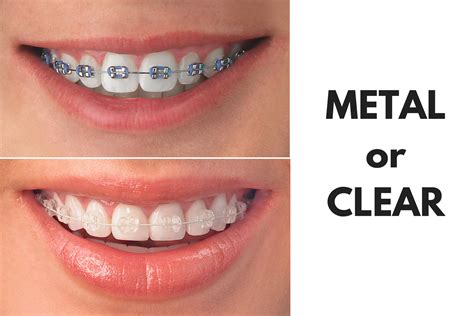 metal vs ceramic brackets|ceramic braces vs metal cost.